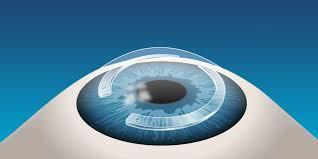 افضل دكتور زراعة وتثبيت القرنية